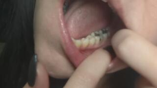 Tour of my mouth & dental work