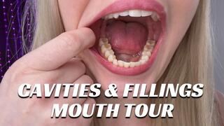 Cavaties and Fillings Mouth Tour