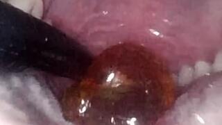Endoscopic swallowing: view of the gummy's journey from the mouth to the stomach