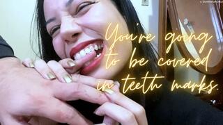 his hands and fingers completely bitten