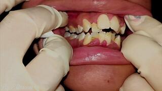 Dirty teeth and lots of plaque (close-up)