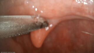uvula manipulation with swab and forceps (720 mp4)
