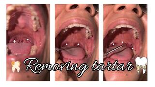 Removing tartar from my throat