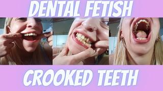 Examining my teeth And crooked teeth