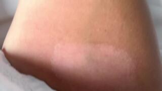 TAN LINES AND SKIN PEEL