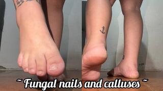 Fungal nails and calloused heels