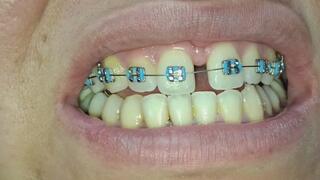 The imperfections of my teeth with my braces