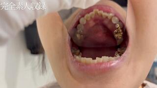 Amateur , Oral Fetish – It’s a Miracle to See This. A 20-Year-Old with Gold Teeth, Completely Recorded in Full Detail.