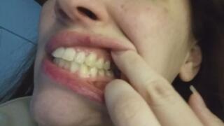 My teeth up close, my jaw from the inside