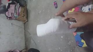 PE WITH PLASTER SPLINT