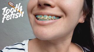 Brushing my yellow teeth while wearing braces