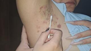 axilas llena de ampollas