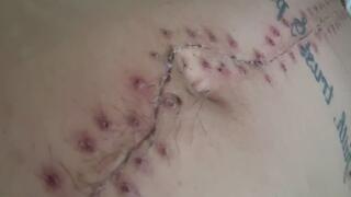 Scar Fetishes Stitches Staples Hospital Recovery After Surgery Teen Petite Small Waist