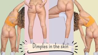 Dimples in the skin
