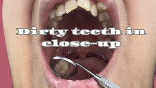 Dirty teeth in close-up
