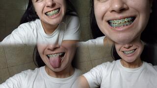 Close-up of yellow teeth with braces