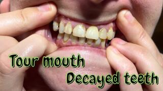 Tour mouth Decayed teeth