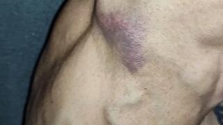 Tempest showing bruise