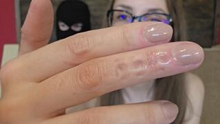 Masked Man Bites my Fingers and Arm Leaving Deep Painful Bitemarks