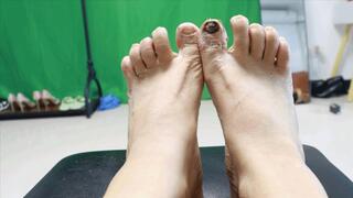4K ERER Onychomycosis