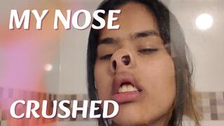 MY NOSE CRUSHED