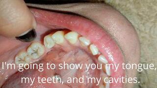 I'm going to show you my tongue, my teeth, and my cavities.