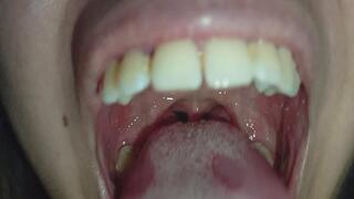 Inflamed and diseased tonsils