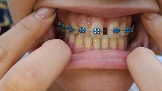 my imperfect teeth “Blue braces, bad girl vibe