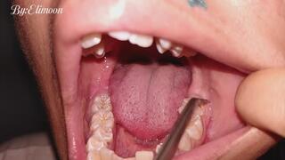 Dental discovery!