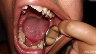 Progress of my wisdom teeth And talking with you all