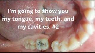 I'm going to show you my tongue, my teeth, and my cavities. #2