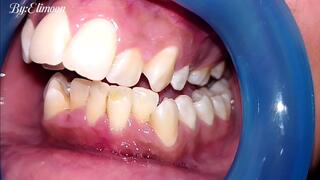 Dental checkup! Showing you the results of the first dental cleaning