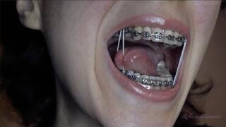 Fixed braces with elastic bands
