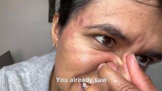 Close-Up Pimple Extraction