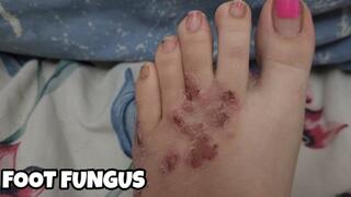 Foot Fungus Show - Chubby Feet Toe Fungus Close Up
