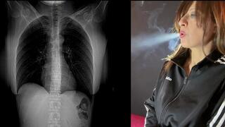 A Visual Guide to My Black Lungs Due to Smoking