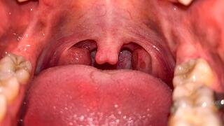 The Uvula During Yawning CUSTOM