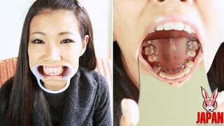 Ortho Obsession: My Journey with Braces, Izumi Asato