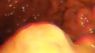 Integral full screen PillCam digestion of orange with clearly visible pieces 720HD