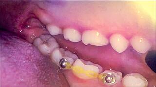 Endoscope: My First Mouth Adventure (Part 2)