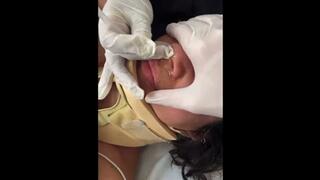 Naso Gastric Feeding Tube Insertion