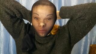 Extreme facial compression