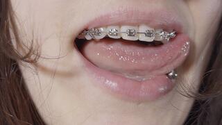 braces close-up and rubber-bands ASMR