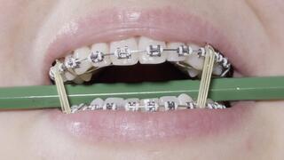 braces close-up with storytelling at the dentist