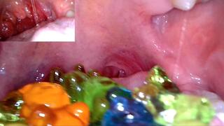 Vore- gummy bears endoscopy