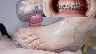 Shoejob with CLEAR UGG and BRACES