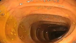 In the medical center for my first double endoscopy of the stomach and intestines 4K