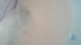 Wart under the armpit