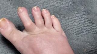 Showing my rough toes with callouses