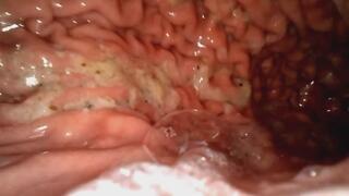 Tiny Lunch (RAW ENDOSCOPE)